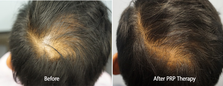 PRP hair loss therapy