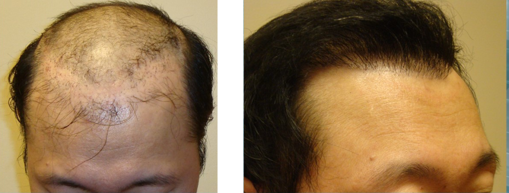 Hair Transplant Repair - Hair Transplant NYC | Hair Transplants New York  City