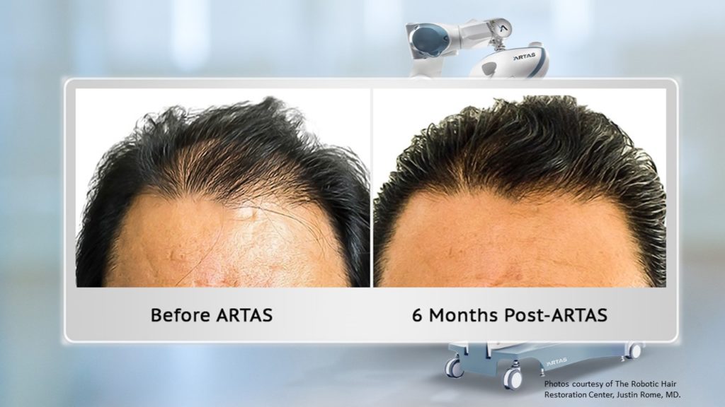 ARTAS Hair Transplant NYC | FUE Hair Transplant New York