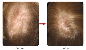 Laser Hair Loss Therapy - Hair Transplant NYC | Hair Transplants New York  City