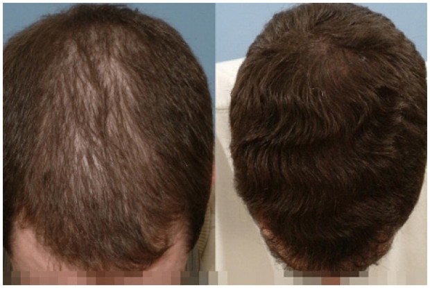 madicle-hair-loss-img-1