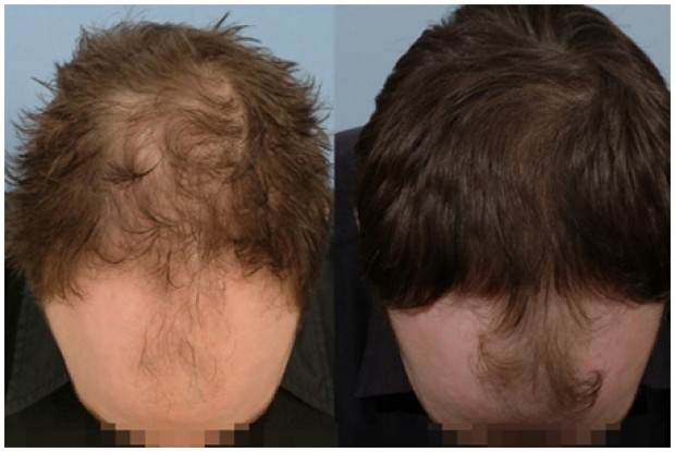 madicle-hair-loss-img-2