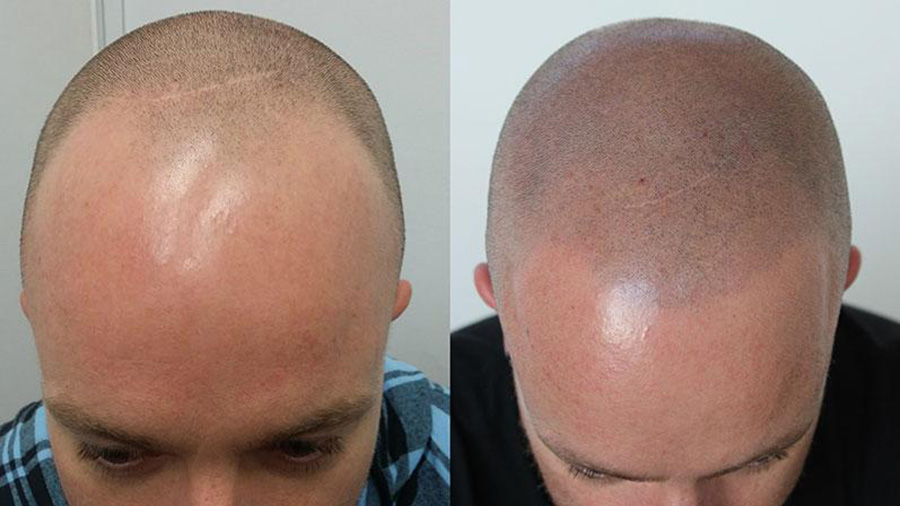 smp-hair-loss-1