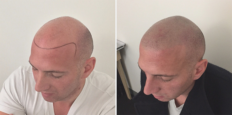 smp-hair-loss-3